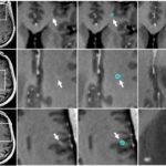 Deeplearning metastase