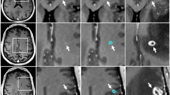 Deeplearning metastase